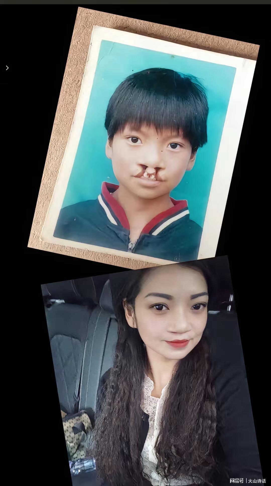 开云棋牌下载-震惊！为声援李亚鹏，一漂亮女孩坦然展示自己唇腭裂手术前后照片